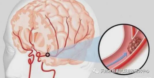 女生突发脑出血 症状是不会说英语