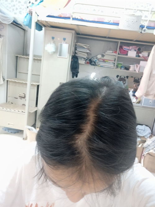 女子因脱发30岁被误认为奶奶